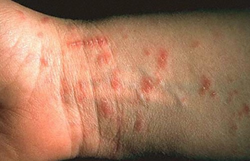 scabies-rash-pictures-2
